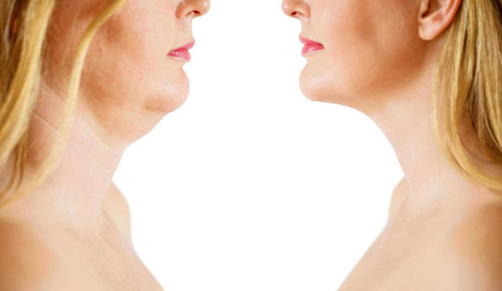 Double Chin treatment Paisley before and after results