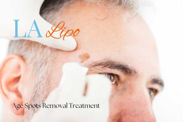 What Are the Most Effective Treatments for Age Spots Paisley?