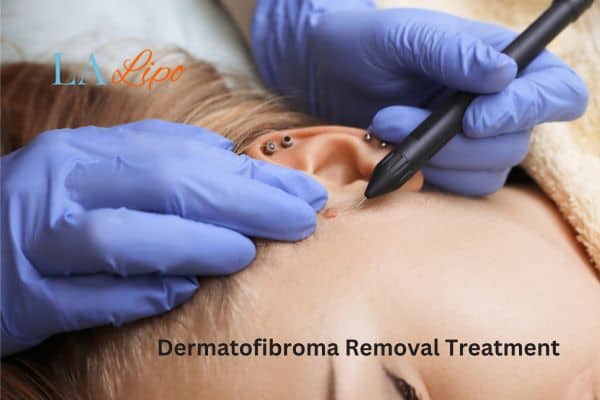 Dermatofibroma Removal Treatment Paisley