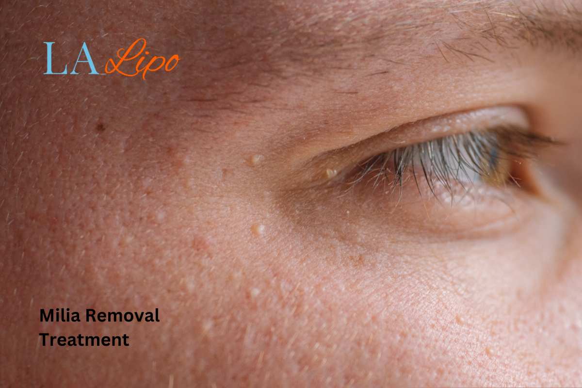 Cryopen Milia Removal: Is It the Easiest and Safest Option Paisley?