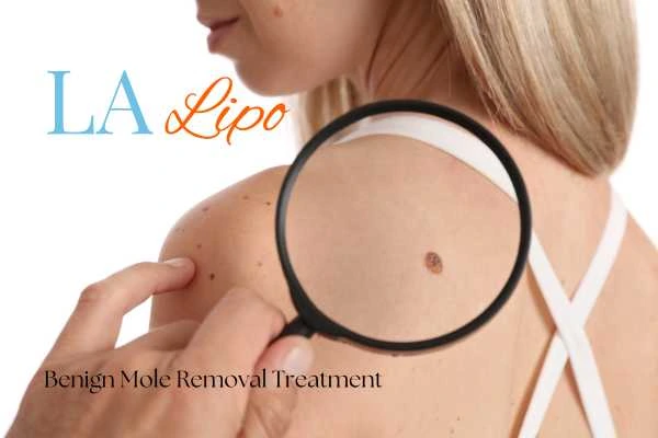 Woman having her inspection of blemish before mole removal Paisley