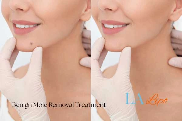 woman's before and after mole removal Paisley results