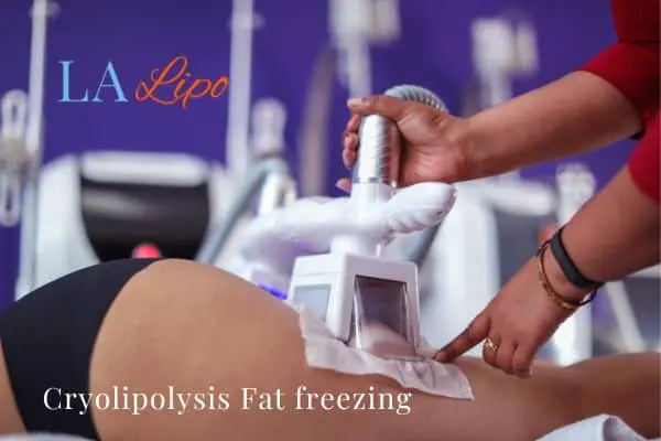 women getting fat freezing Paisley