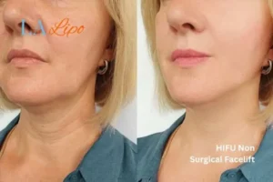 hi-fu for wrinkles Paisley before and after results