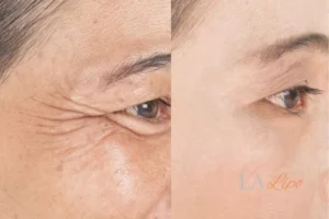 Before and after results of woman - HI-fu wrinkles reduction treatment Paisley