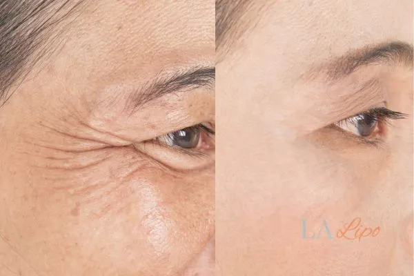 Before and after results of woman - HI-fu wrinkles reduction treatment Paisley