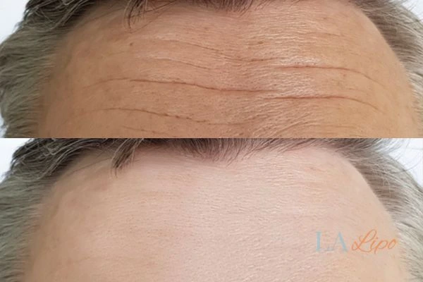results of HIFU Paisley on mans forehead to help reduce lines and wrinkles