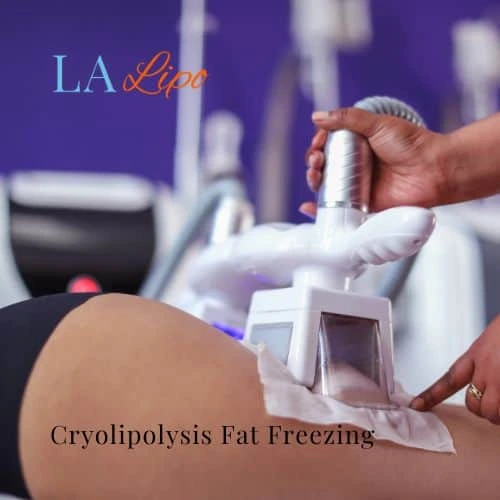 fat freezing - Cryolipolysis Paisley