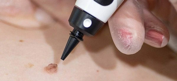 skin tag removal using cryopen Paisley