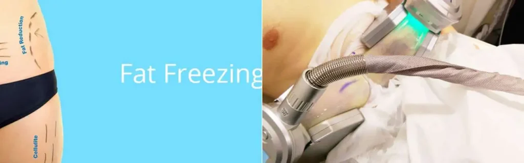 multi areas of a persons body having coolsculpting Paisley treatment