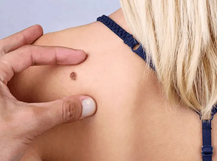 woman having mole removal Paisley consultation before treatment.