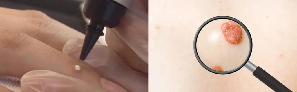 Cryopen for mole removal Paisley - speak to our team today!