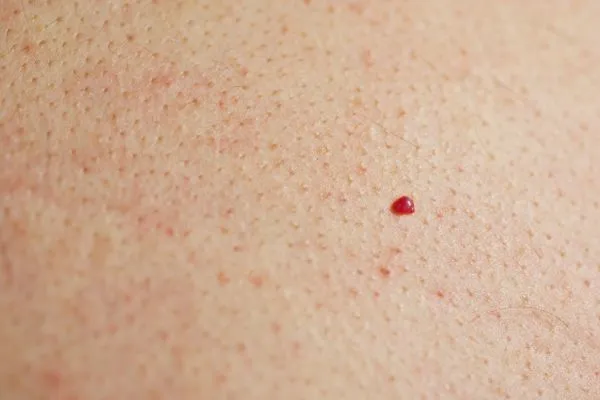 close up of a cherry angioma Paisley