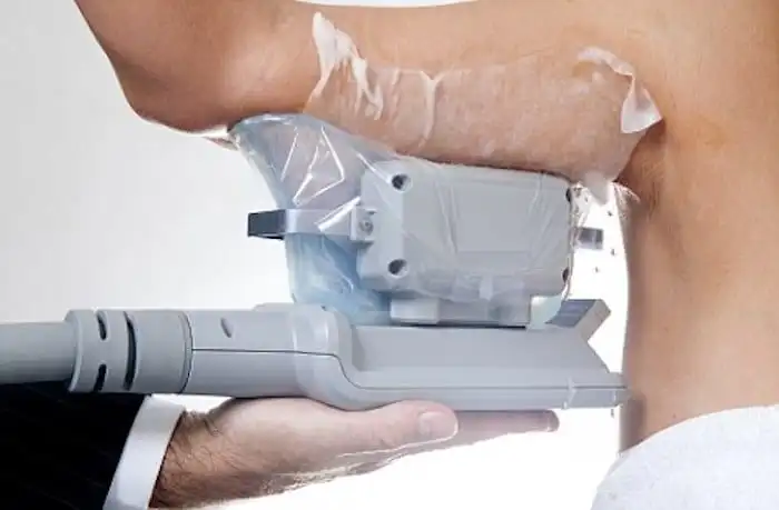 Picture of fat freezing Paisley on the upper arms.