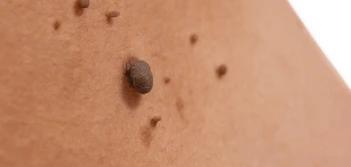 image of a skin tag Paisley