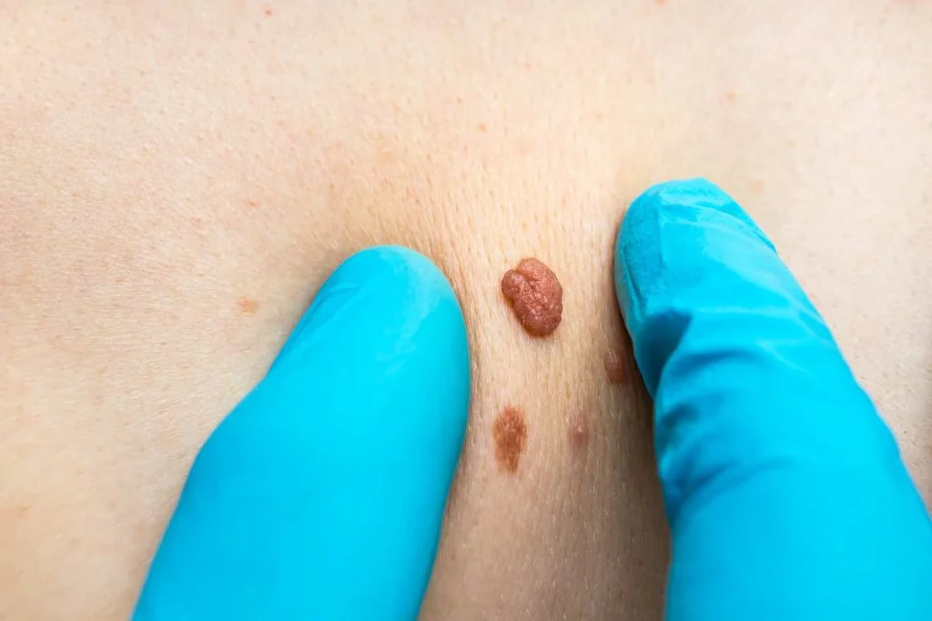 Consultant examining a skin tag Paisley