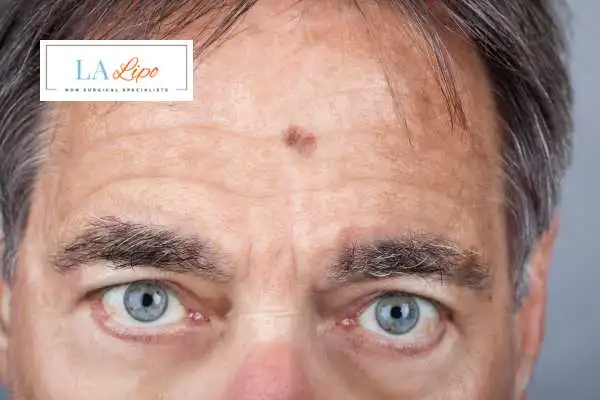 Solar Lentigo Removal Paisley image of man with mark on his forehead