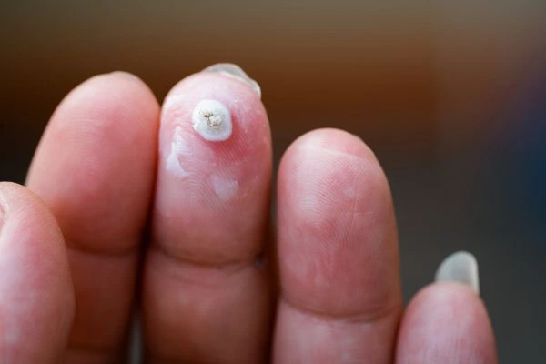 wart on person finger - cryotherapy to treat from LA LIPO Paisley