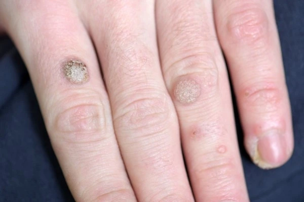 photo of warts on person hand - see wart removal Paisley from LA LIPO