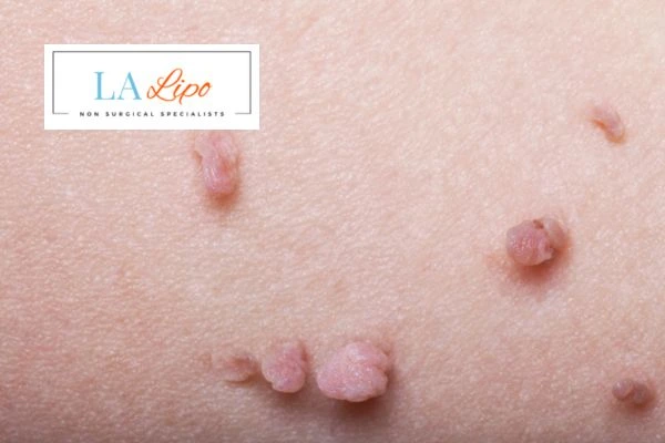 Does cryopen skin tag removal Paisley hurt? Find out now call our team today!