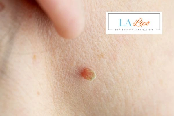 Book skin tag removal Paisley today speak to our team now!