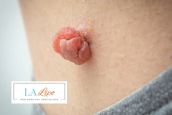 Interested in skin tag removal Paisley? Concerned about the pain? Find out more today!
