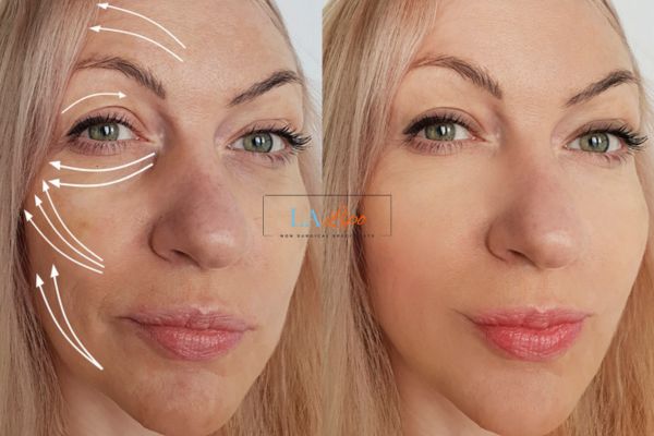 Morpheus 8 results Paisley face lift.