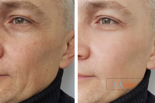 See the amazing results of Morpheus8 Treatment Paisley!
