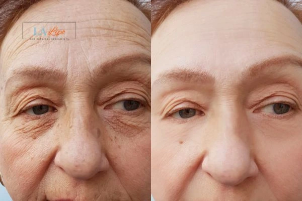 The powerful benefits of Morpheus8 Treatment Paisley - Call Our team today!