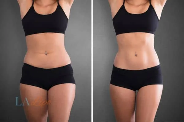 before and after results of non-surgical treatment to help a woman's body image and mental health Paisley