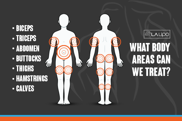 Diagram to show areas you can have LA-EMS Body Sculpting Treatment Paisley