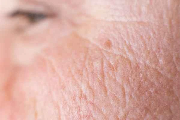 close up picture of a woman's face showing an age spot Paisley