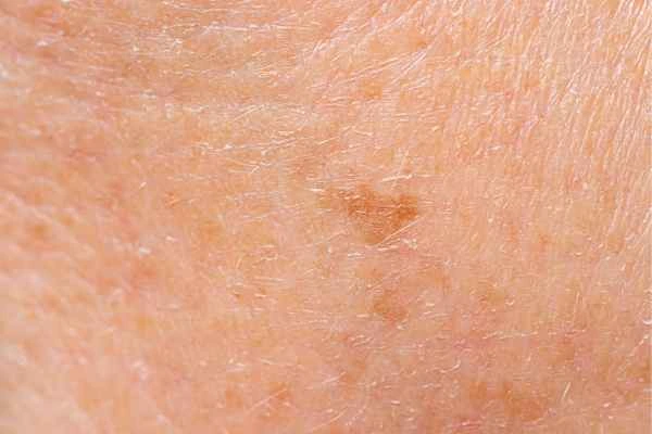 close up picture of age spots Paisley
