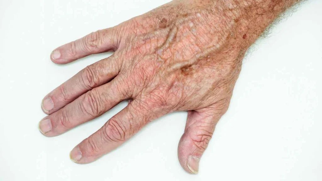Male hand showing age spot Paisley