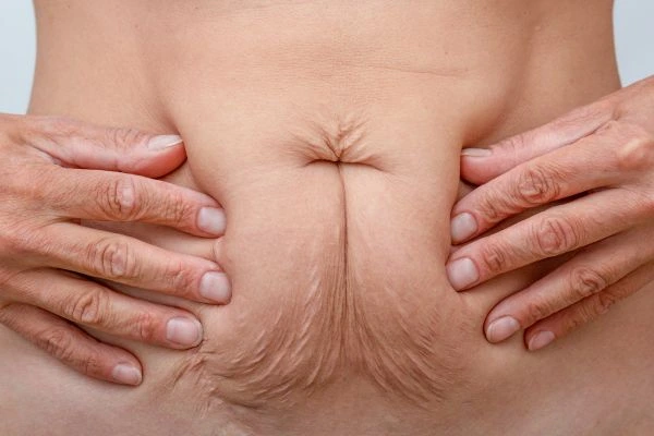 Image of a woman's stomach with loose skin - example of skin tightening Paisley options